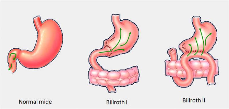 Alkalen Refl Gastrit